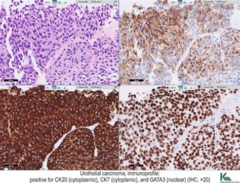 GATA3 as a valuable marker to distinguish clear cell papillary .